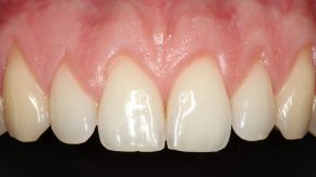 retração-gengival-não-volta-com-o-tempo-post